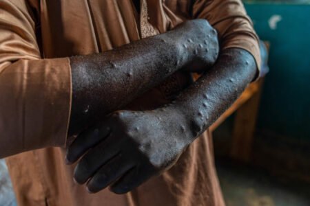 France detects first case of recent mpox variant
| EUROtoday